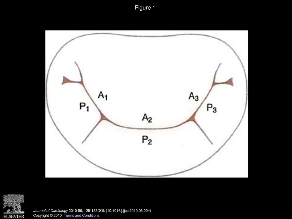Figure 1 Carpentier classification of mitral valve leaflet structure. The mitral valve is viewed from the left atrium. A: anterior; P: posterior.