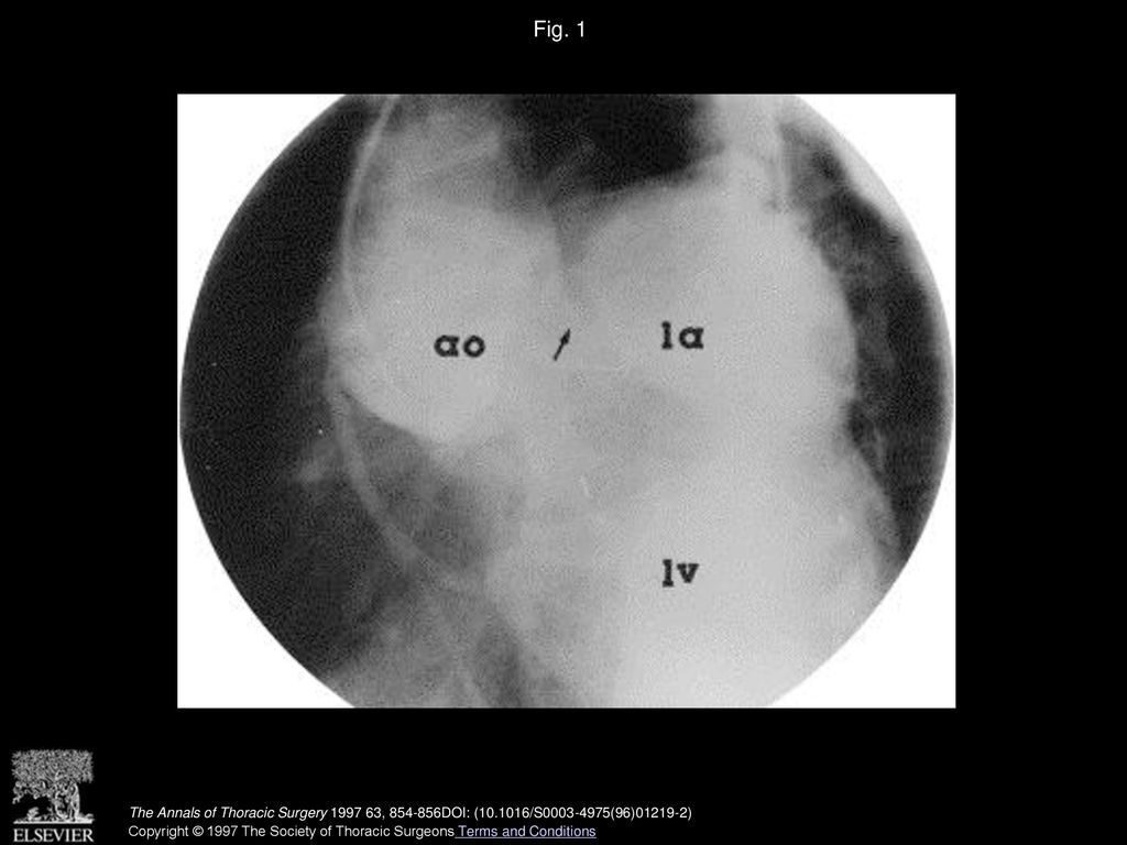 Fig. 1 Anteroposterior aortogram showing aorto–left atrial fistula (arrow). (ao = ascending aorta; la = dilated left atrium; lv = left ventricle.)