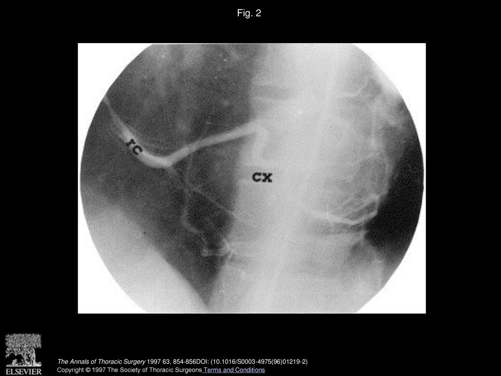 Fig. 2 Selective right coronary angiogram showing that the circumflex coronary artery (cx) originated from the right coronary artery (rc).