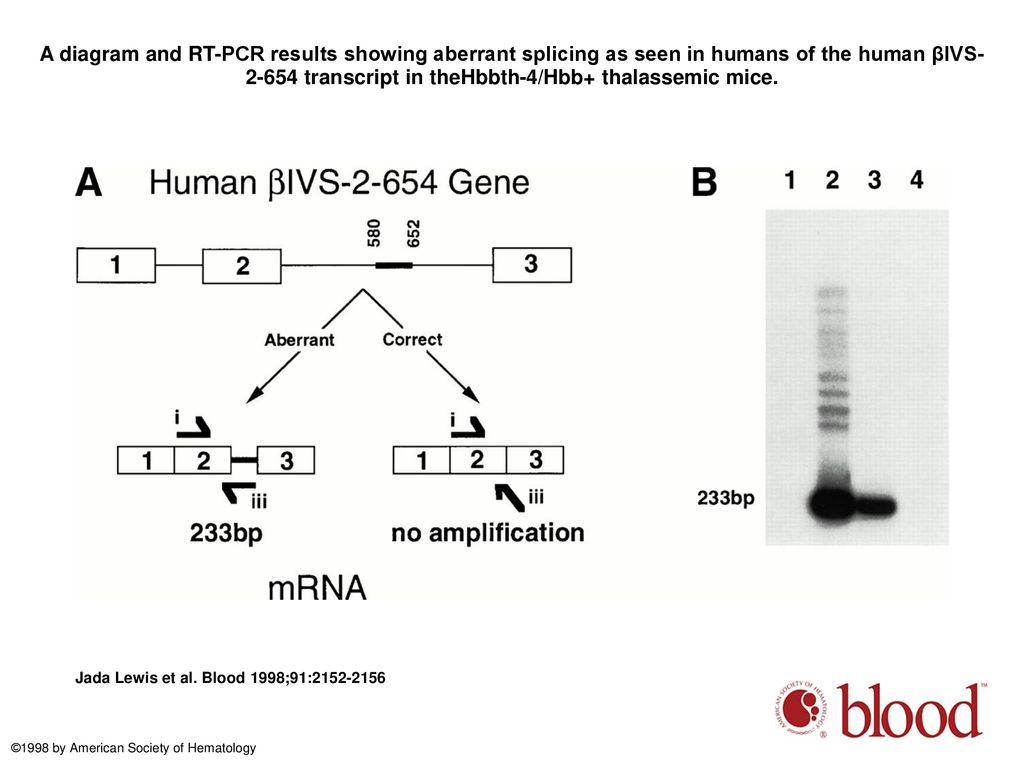 A diagram and RT-PCR results showing aberrant splicing as seen in humans of the human βIVS transcript in theHbbth-4/Hbb+ thalassemic mice.