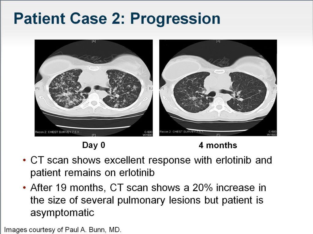 Patient Case 2: Progression