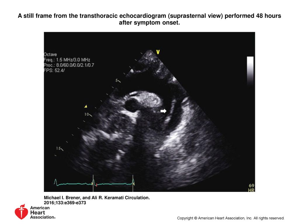 A still frame from the transthoracic echocardiogram (suprasternal view) performed 48 hours after symptom onset.