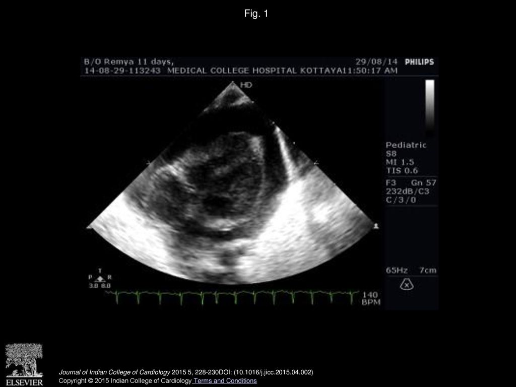 Fig. 1 Two dimensional echocardiogram subcostal view showing massive pericardial effusion.