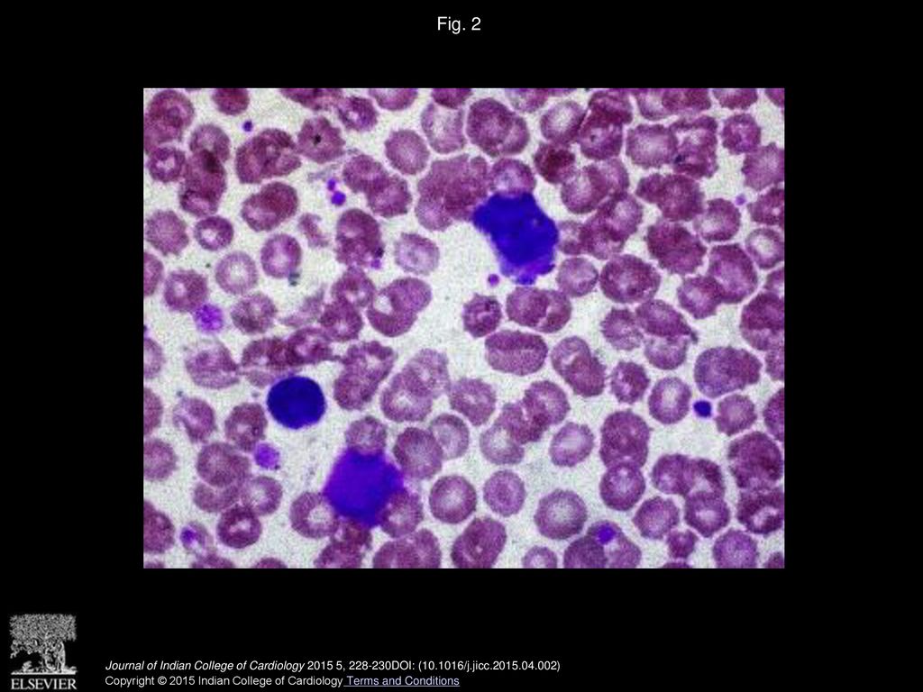 Fig. 2 Peripheral smear examination showing normocytic normochromic RBCs and blast cells and reduced number of platelets.