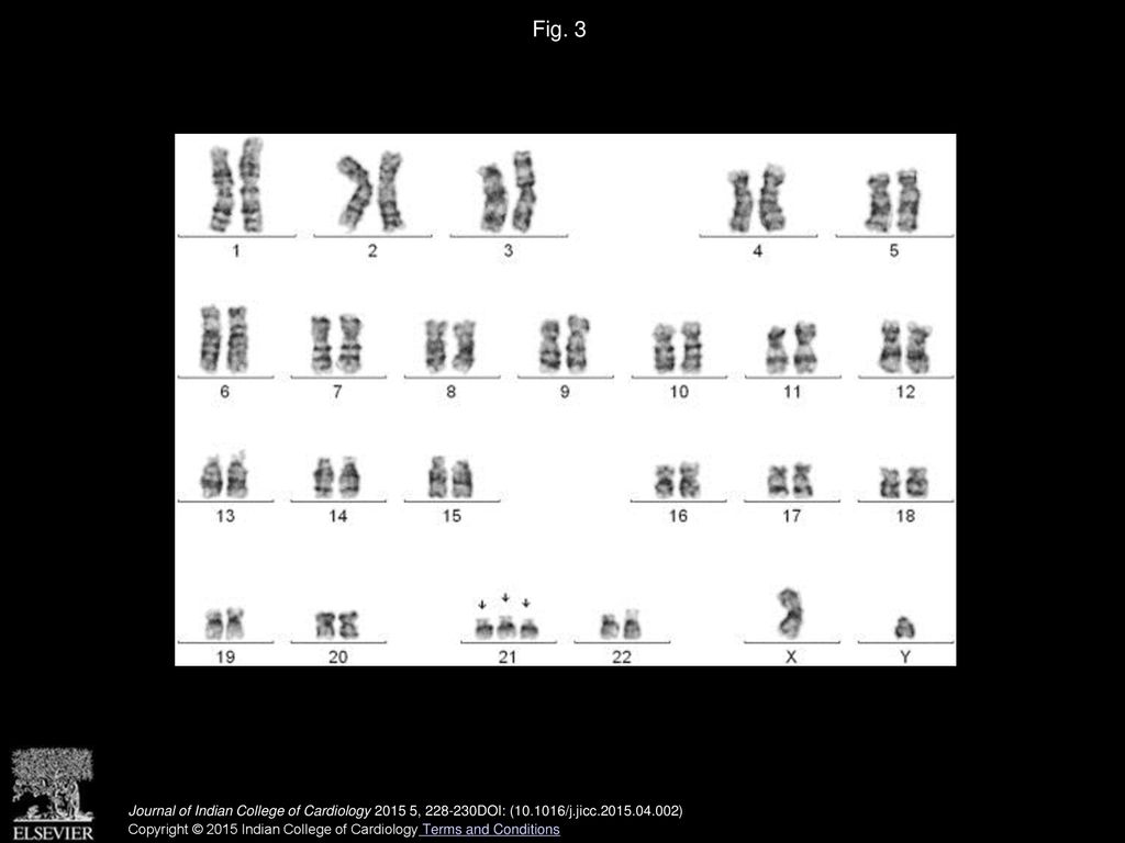 Fig. 3 Chromosomal analysis (GTG banding with 500 band resolution) showing male karyotype with trisomy 21 pattern suggestive of Down syndrome.