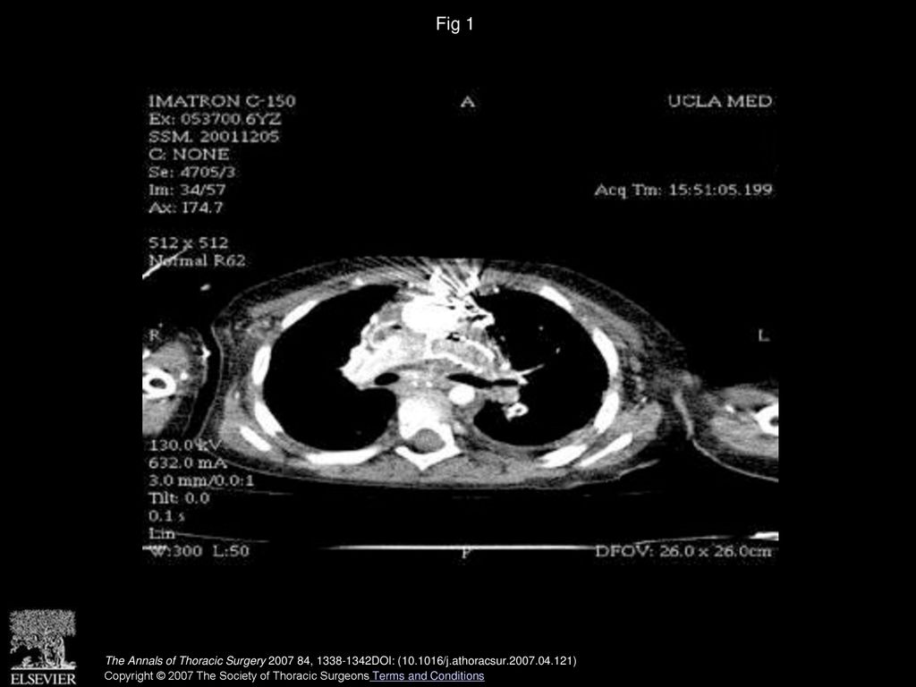 Fig 1 Computed tomography of the chest demonstrates the postoperative result of left pulmonary artery stenting.