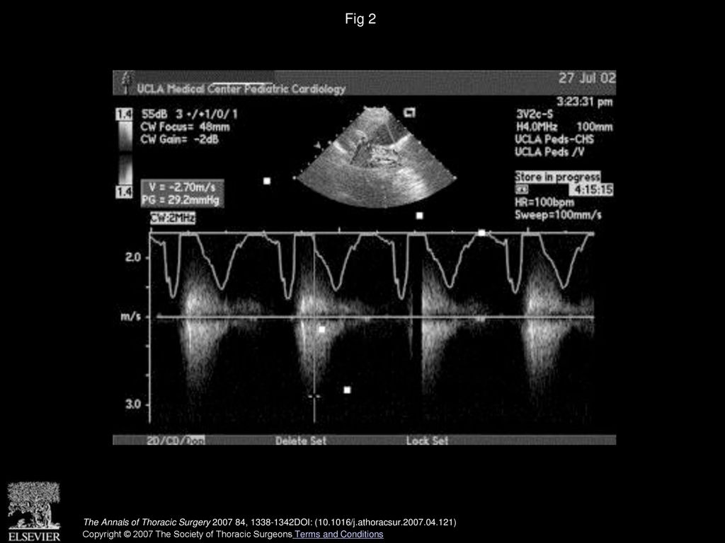 Fig 2 Preoperative color Doppler echocardiogram showing left pulmonary artery stenosis with a peak pressure gradient of 29.2 mm Hg.