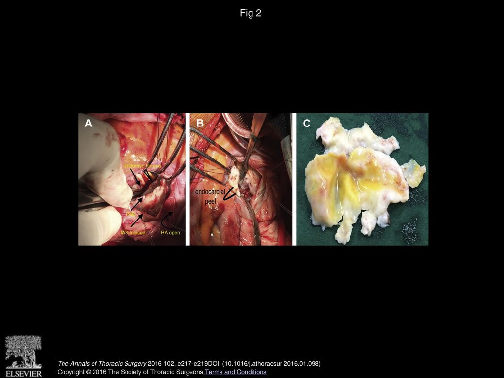 Fig 2 (A, B) Intraoperative pictures. (C) Endocardiectomy specimen. (IAS = interatrial septum; PML = posterior mitral leaflet; RA = right atrium.)
