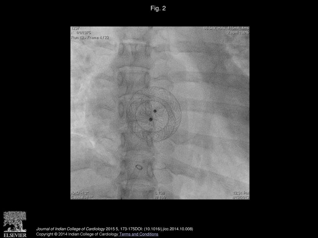 Fig. 2 Image showing in situ Amplatzer septal occlusion device following successful percutaneous delivery.