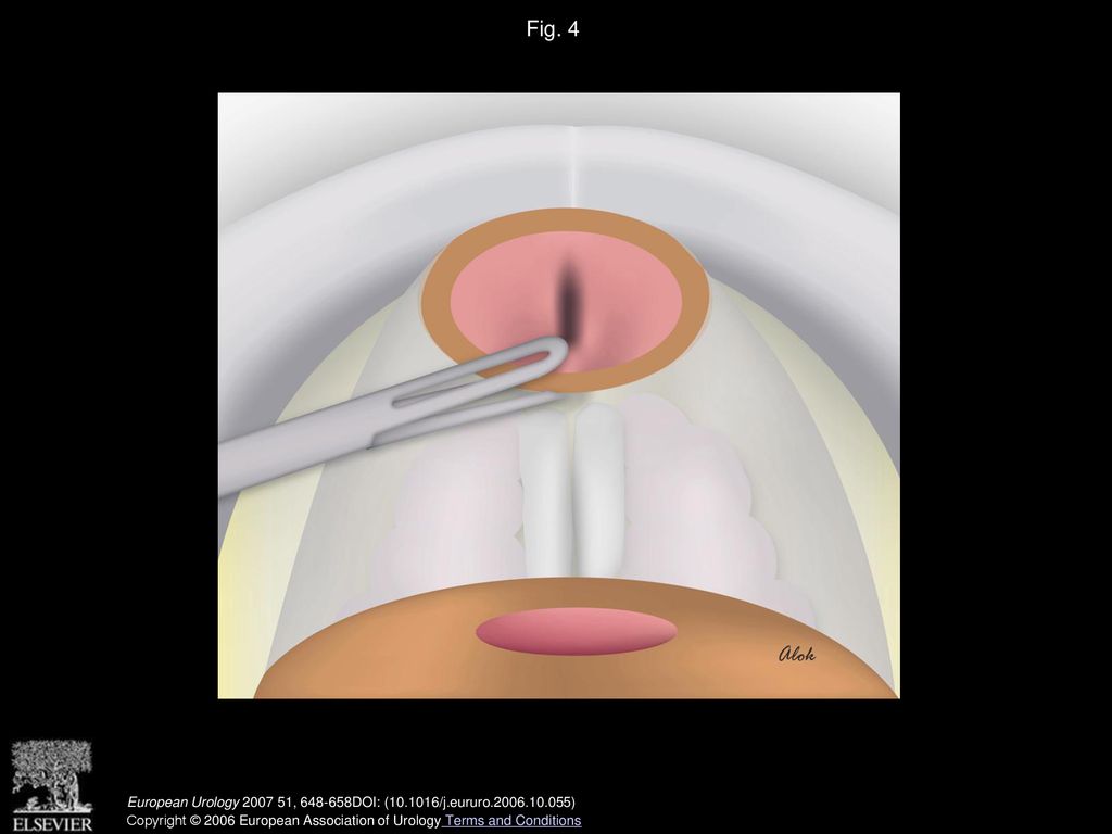 Fig. 4 Exposure of anterior layer of Denonvilliers fascia.