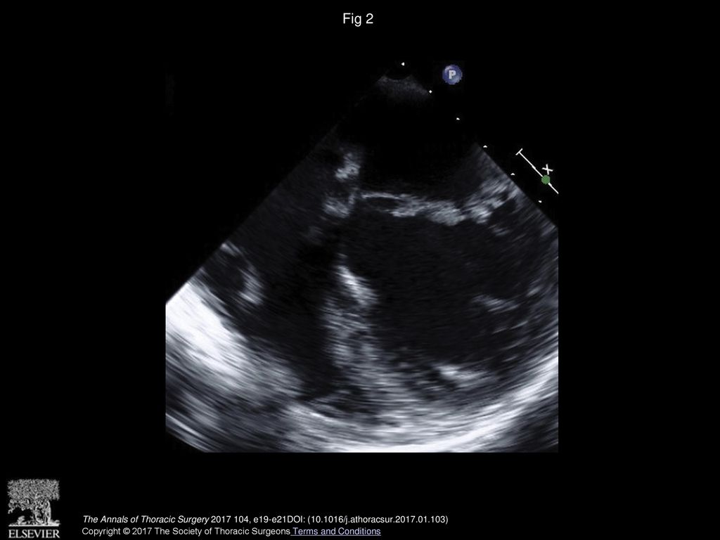 Fig 2 Preoperative transoesophageal echocardiographic view demonstrating thickening of both atrioventricular valves.