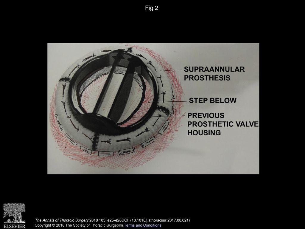 Fig 2 Schematic drawing showing valve above previous mechanical ring annulus.