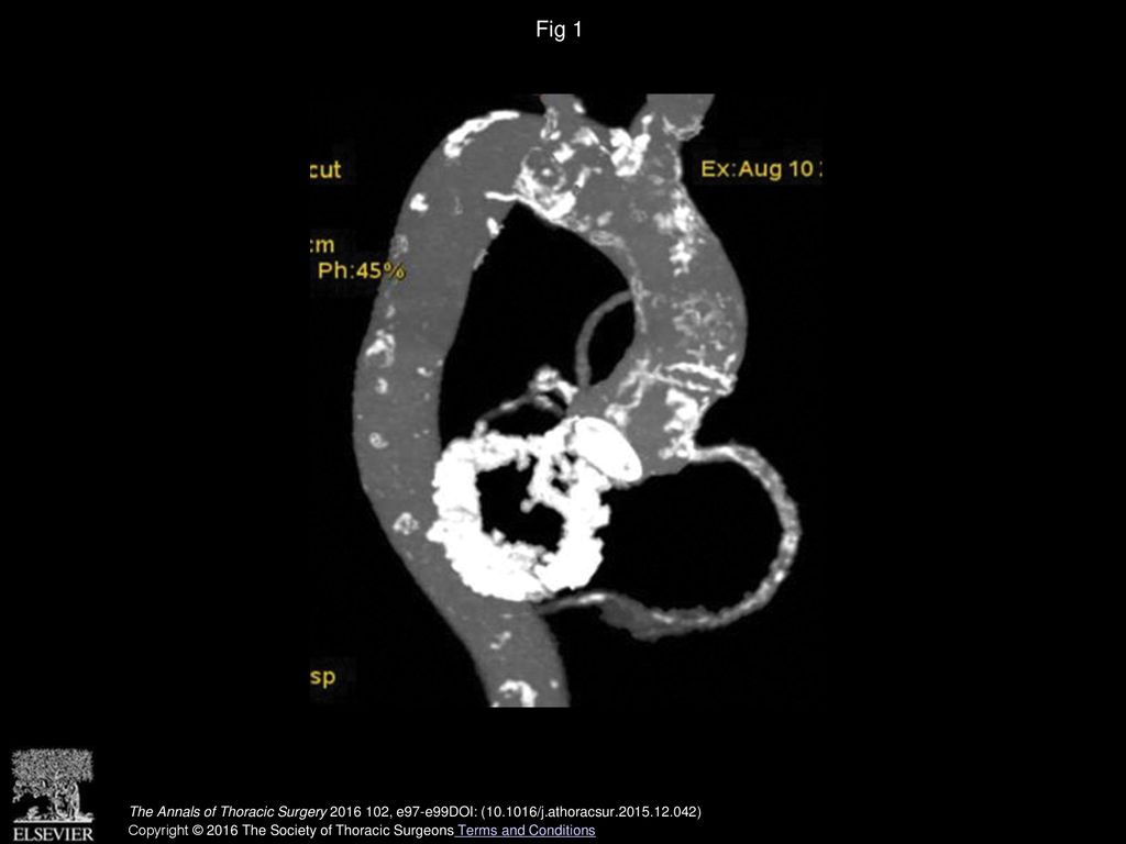 Fig 1 Computed tomographic (CT) scan showing porcelain aorta with circumferential mitral annular calcification.