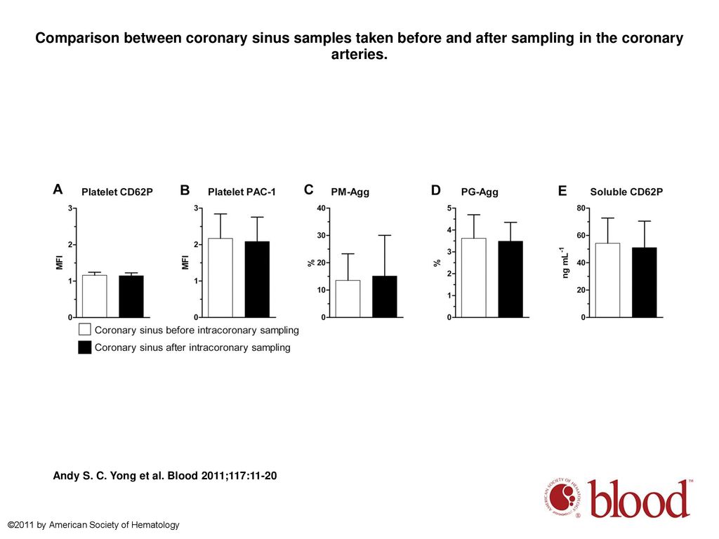 Comparison between coronary sinus samples taken before and after sampling in the coronary arteries.