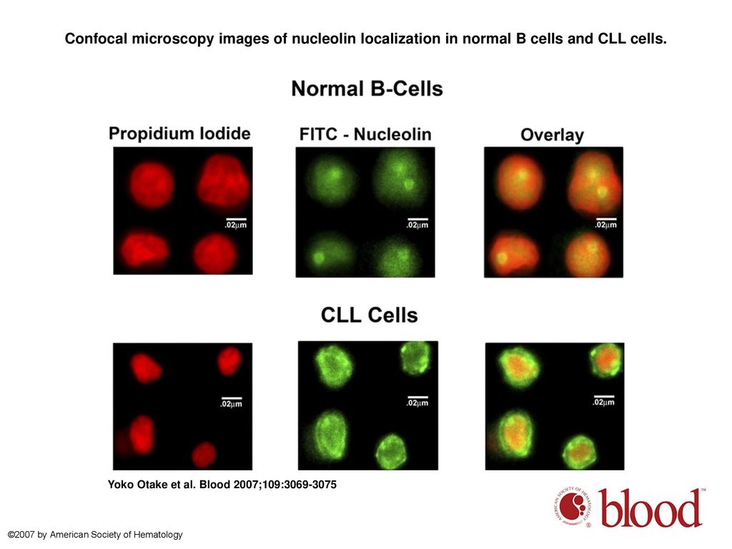 Confocal microscopy images of nucleolin localization in normal B cells and CLL cells.