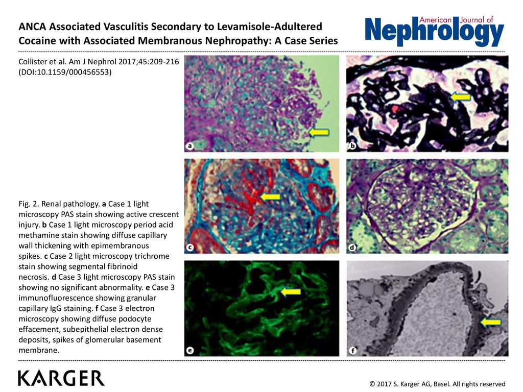 ANCA Associated Vasculitis Secondary to Levamisole-Adultered Cocaine with Associated Membranous Nephropathy: A Case Series