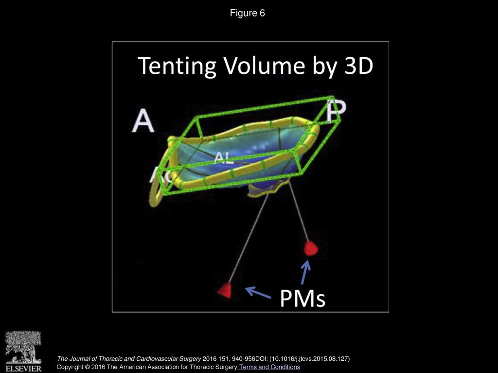 Figure 6 Measurement of tenting volume used in 3D echocardiography. AO, Aorta; AL, anterolateral; PMs, papillary muscles.