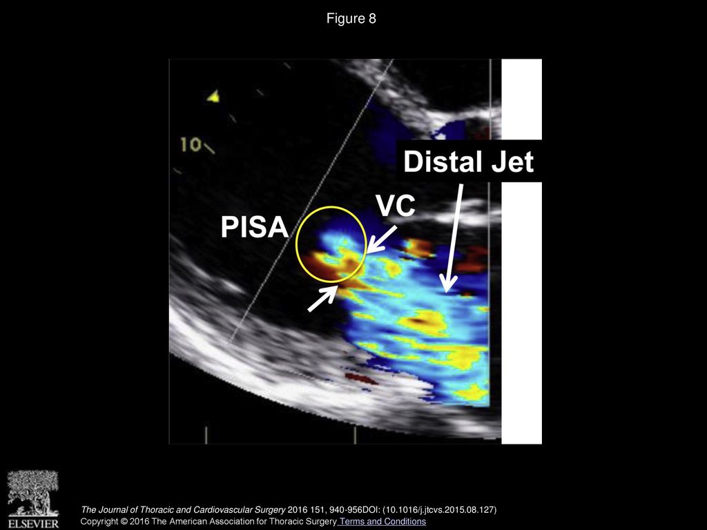 Figure 8 Measurement of distal jet area by Doppler echocardiography. PISA, Proximal isovelocity surface area; VC, vena contracta.