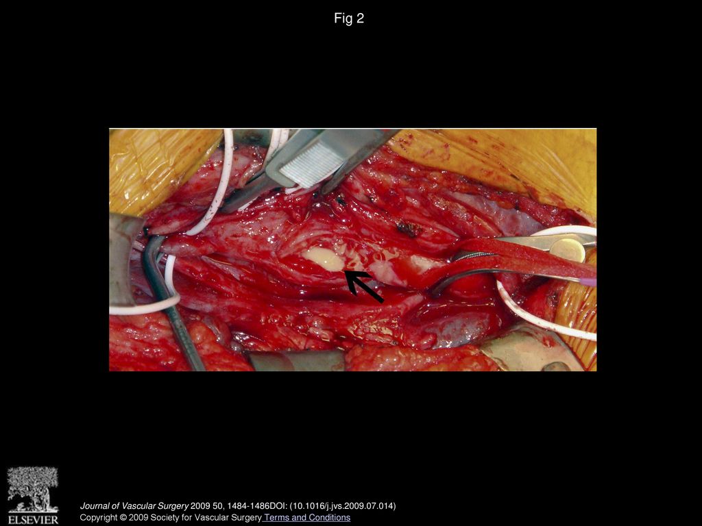 Fig 2 Intraoperative photograph demonstrating pus within the extracranial infected carotid artery aneurysm (arrow).