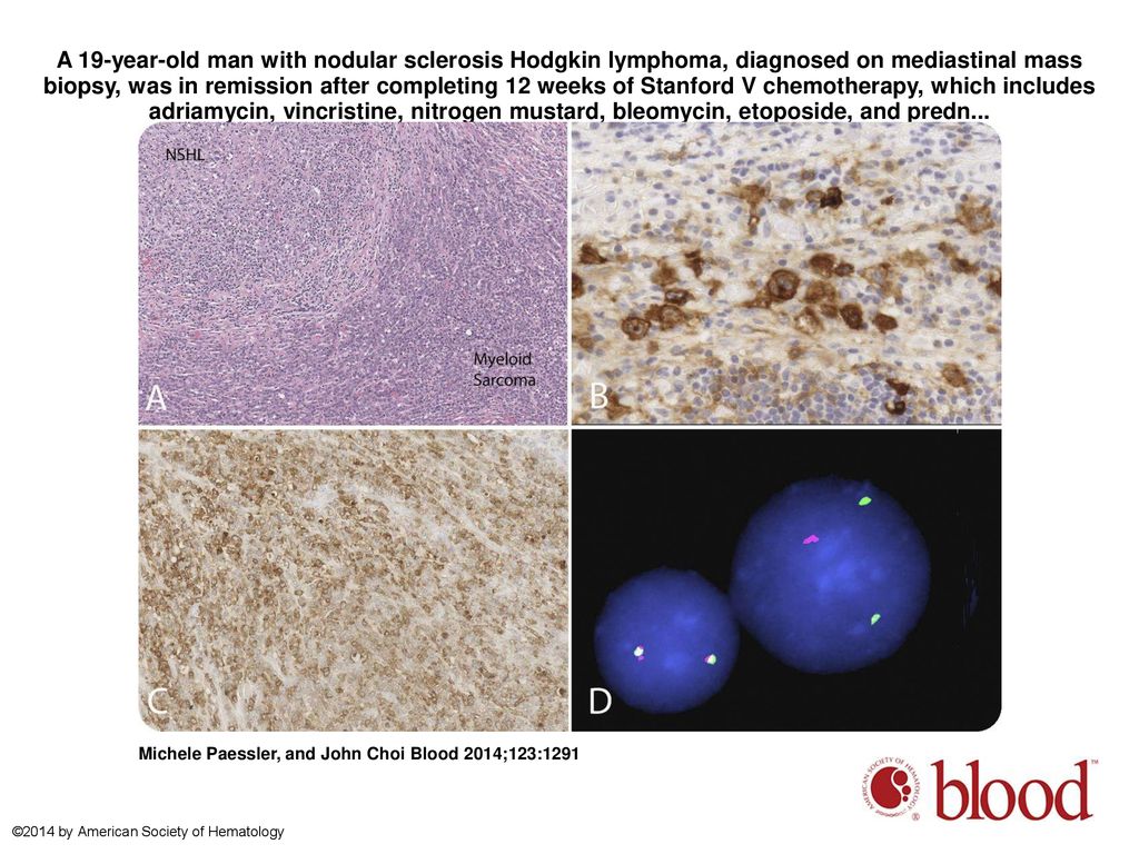 A 19-year-old man with nodular sclerosis Hodgkin lymphoma, diagnosed on mediastinal mass biopsy, was in remission after completing 12 weeks of Stanford V chemotherapy, which includes adriamycin, vincristine, nitrogen mustard, bleomycin, etoposide, and predn...