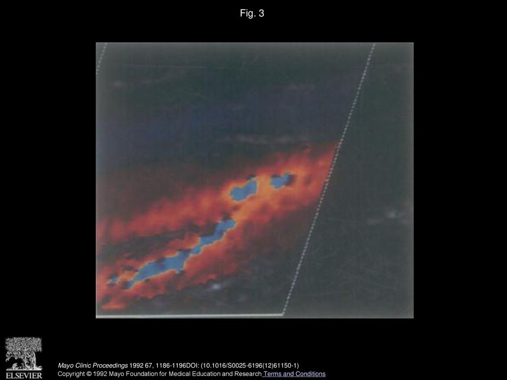 Fig. 3 Color flow Doppler image of Figure 2. This view of carotid bifurcation is possible in only a few cases.
