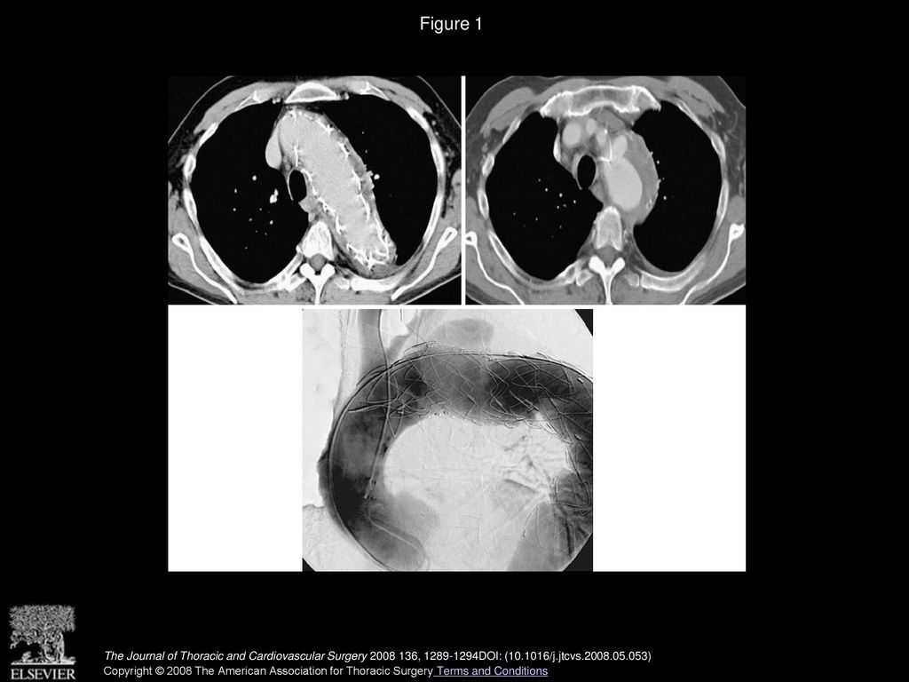 Figure 1 Persistent type Ia endoleak after two endovascular reinterventions.
