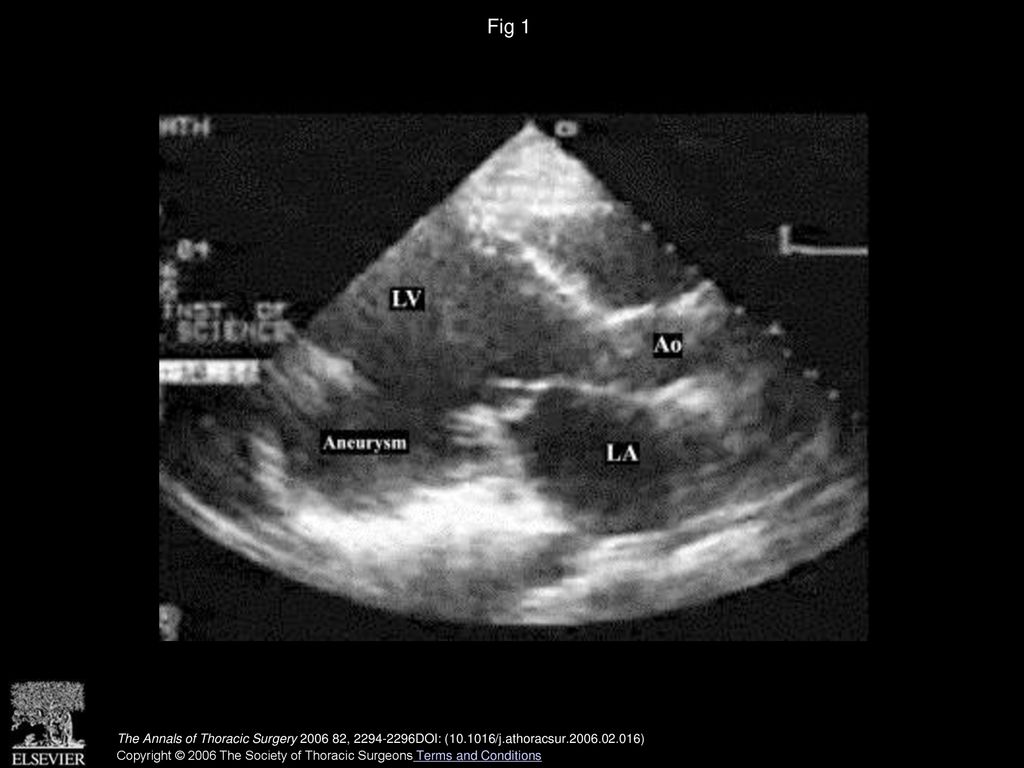 Fig 1 Preoperative transthoracic echocardiogram showing posterior wall aneurysm. (Ao = aorta; LA = left atrium; LV = left ventricle.)