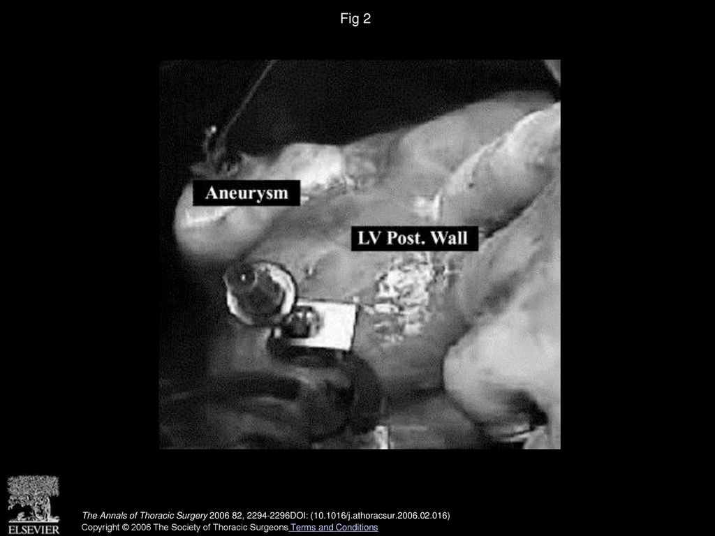 Fig 2 Intraoperative diagram with large posterior left ventricular pseudoaneurysm. (LV post. wall = left ventricle posterior wall.)