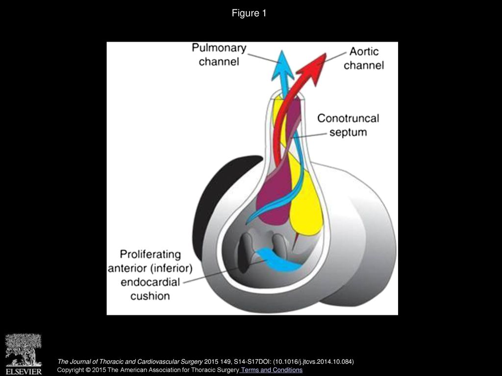 Figure 1 Normal septation of the conotruncus in heart development. Reprinted from