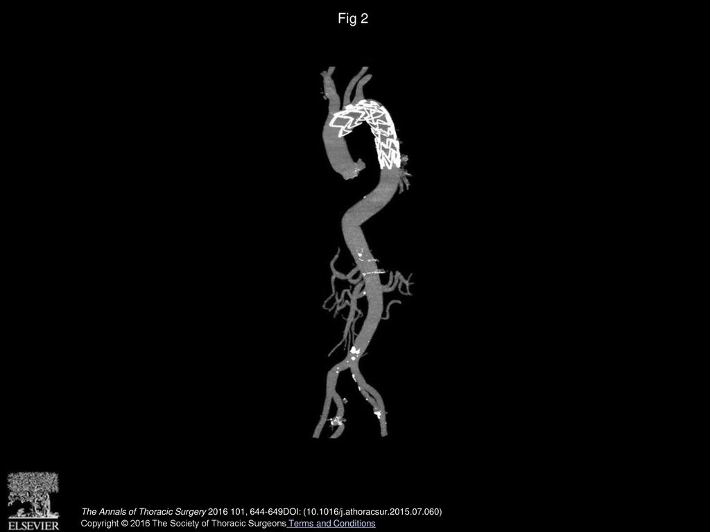 Fig 2 A postoperative computed tomography scan shows that there is no space or blood flow surrounding the fenestrated stent graft.