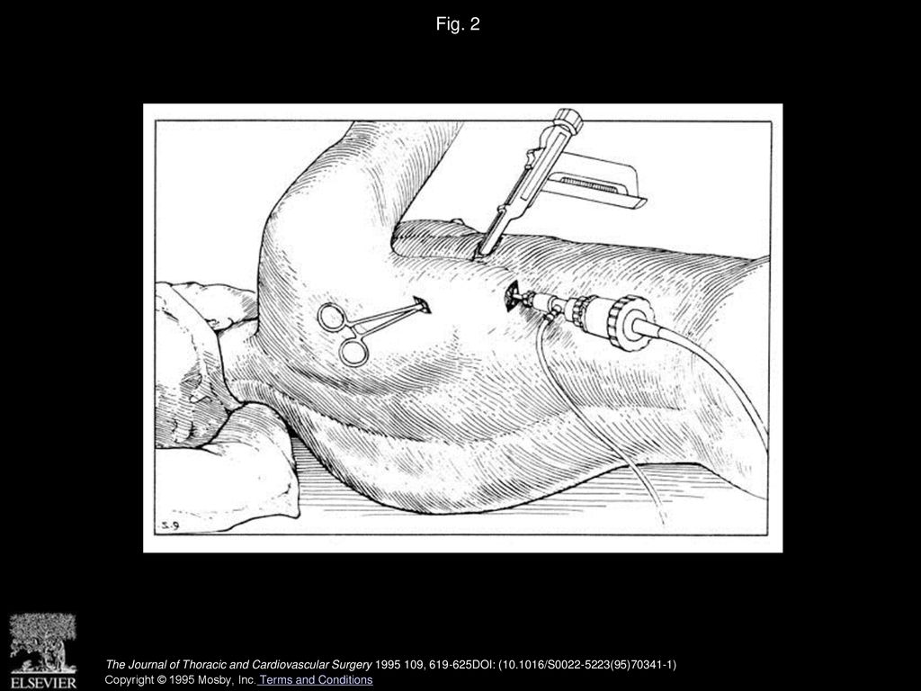 Fig. 2 Patient position and incisions.
