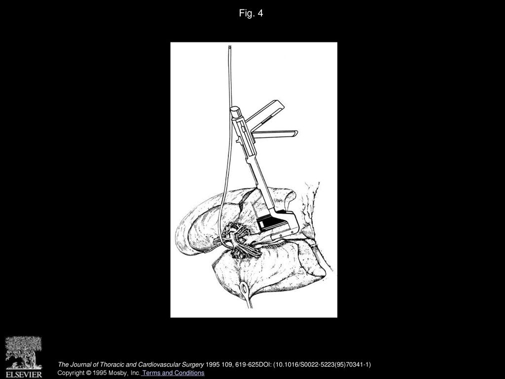 Fig. 4 TL60 stapler being guided by a red rubber catheter.