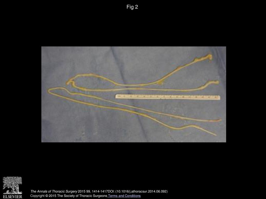 Fig 2 Looped nerve allografts prior to transplantation.