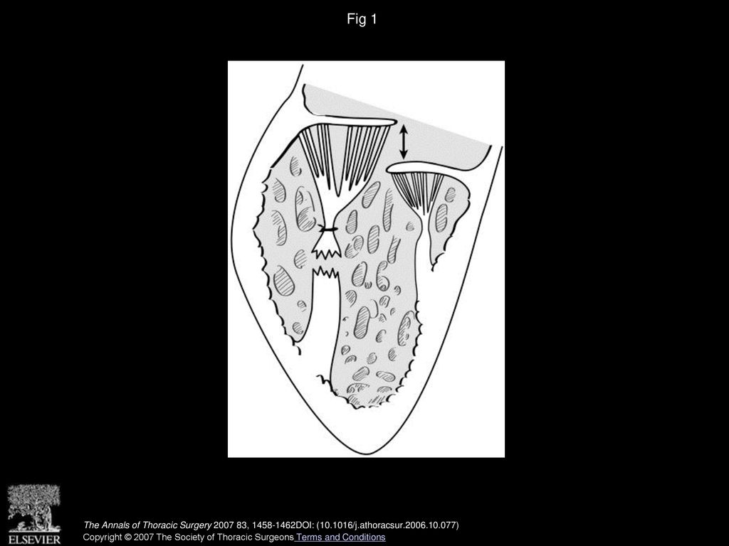 Fig 1 Valve insufficiency secondary to a ruptured papillary muscle (arrow).