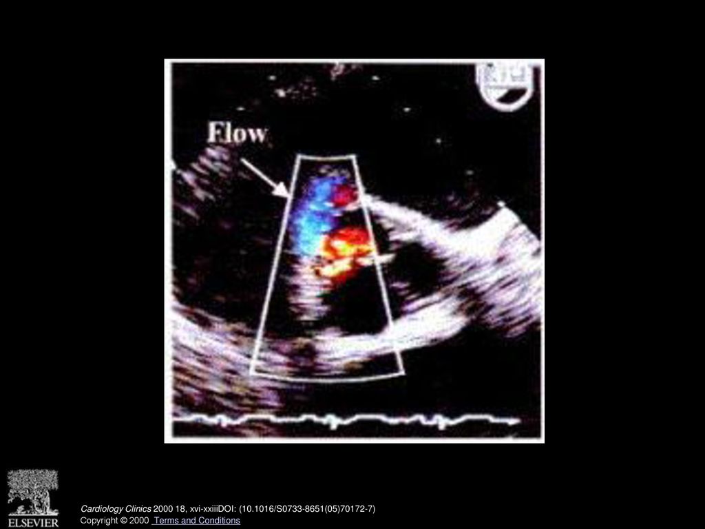Pseudoaneurysm formation (arrow) is demonstrated by color Doppler imaging showing flow into the abscess cavity. (See also page 777, Fig. 2 in article by Ryan and Bolger.)