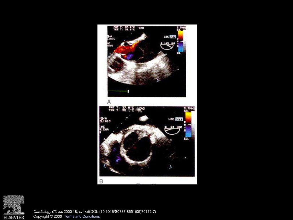 A, Long-axis view of the ascending aorta at 143° with color Doppler, showing an entry site into the false lumen. Note spontaneous echo contrast (smoke) in the false lumen. B, Short-axis view at 24° of a dissection of the ascending aorta, showing the flap and the two lumina. Note spontaneous echo contrast in the false lumen. (See also page 811, Fig. 1 in article by Flachskampf and Daniel.)