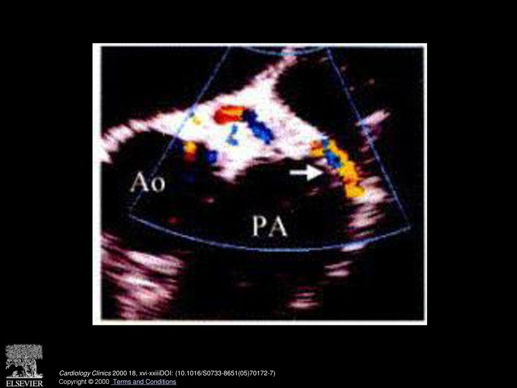 Coronary artery to pulmonary artery (PA) fistula (coronary A-V fistula). Color Doppler image of coronary A-V fistula using TEE. Note fistula from the left anterior descending coronary artery to pulmonary artery (arrow). (See also page 837, Fig. 6 in article by Youn and Foster.)