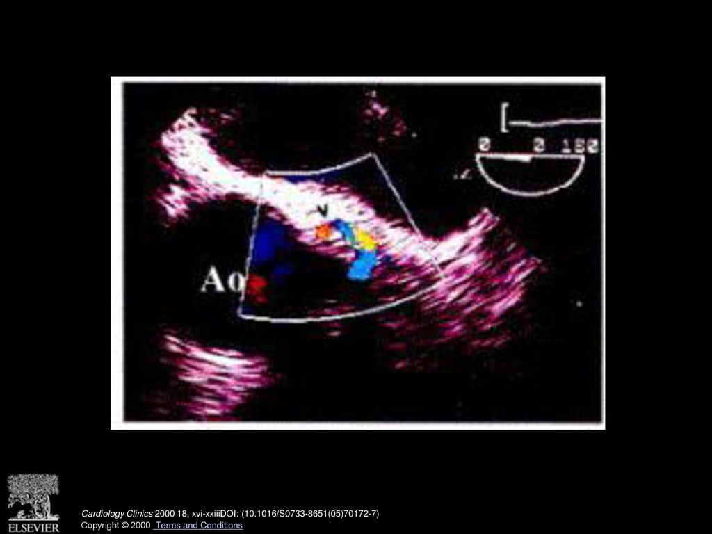 Color Doppler image of left main coronary artery shows flow aliasing (arrowhead). (See also page 838, Fig. 7 in article by Youn and Foster.)