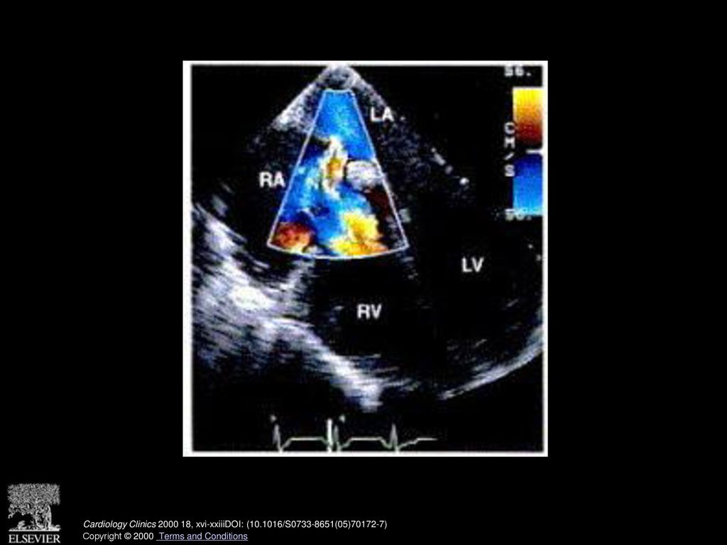 Transesophageal transverse plane view of secundum atrial septal defect demonstrating left to right atrial shunting by color flow Doppler in the region of the fossa ovalis. RA = right atrium; LA = left atrium; RV = right ventricle; LV = left ventricle. (See also page 868, Fig. 5 in article by Miller-Hance and Silverman.)