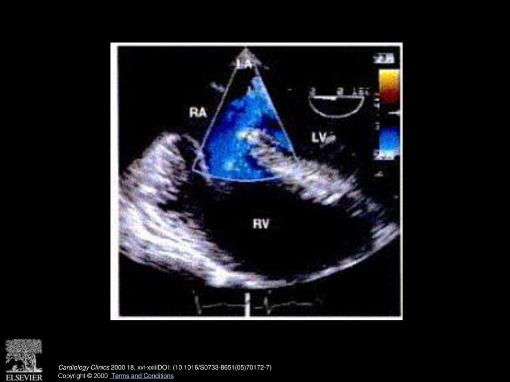 Transesophageal transverse plane view of primum atrial septal defect showing the extension of the defect from the lower edge of the atrial septum to the level of the atrioventricular (AV) valves and the corresponding shunt by color Doppler echocardiography. RA = right atrium; LA = left atrium; RV = right ventricle; LV = left ventricle. (See also page 870, Fig. 7 in article by Miller- Hance and Silverman.)