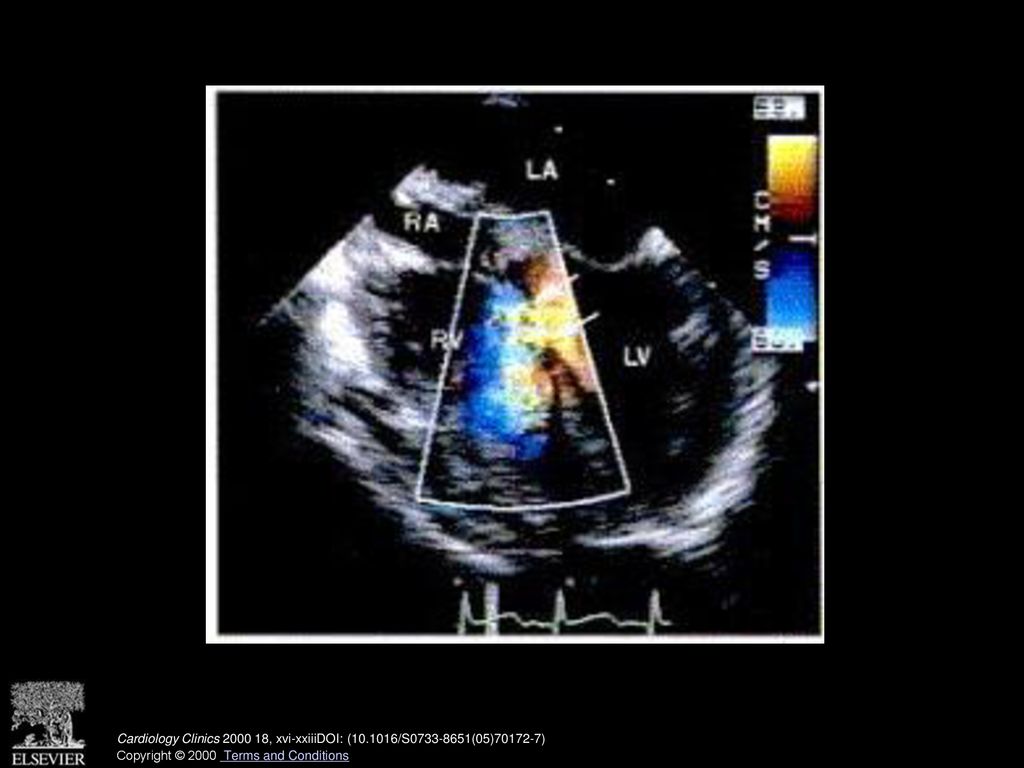 Transesophageal transverse plane view of perimembranous ventricular septal defect with color flow Doppler demonstrating the ventricular left to right shunting. Arrows indicate the location of the ventricular septal defect near the septal leaflet of the tricuspid valve. RA = right atrium; LA = left atrium; RV = right ventricle; LV = left ventricle. (See also page 871, Fig. 9 in article by Miller- Hance and Silverman.)