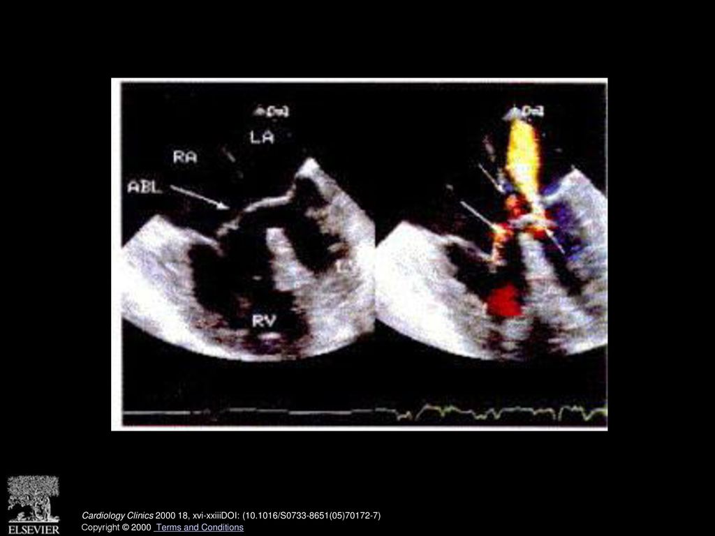 Transverse plane view of complete atrioventricular septal defect (AV canal defect) in end- diastolic frame (left) demonstrating the anterior bridging leaflet (arrow) and the extent of the interatrial and interventricular communications. Right, Color flow mapping of the defect shows multiple regurgitant jets through the right and left components of the common AV valve (arrows). RA = right atrium; LA = left atrium; RV = right ventricle; LV = left ventricle; ABL = anterior bridging leaflet. (See also page 874, Fig. 12 in article by Miller-Hance and Silverman.)