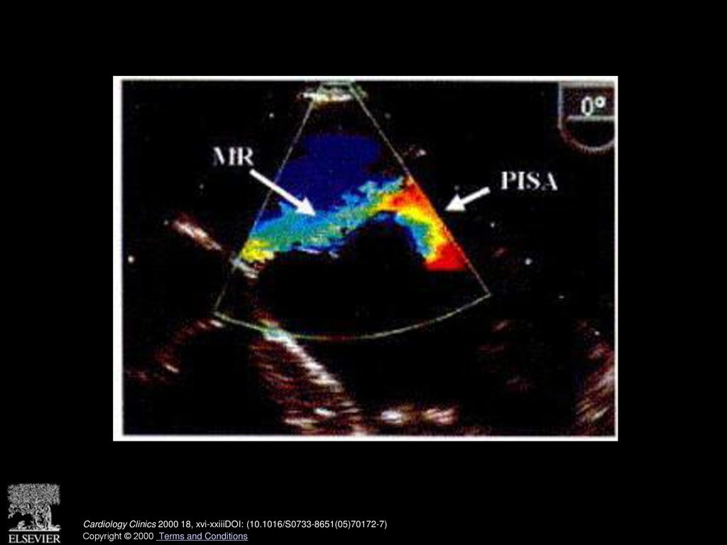 Eccentric and anteriorly directed mitral regurgitation resulting from posterior mitral valve prolapse. MR = mitral regurgitation; PISA = proximal isovelocity surface area. (See also page 741, Fig. 13 in article by Zaroff and Picard.)