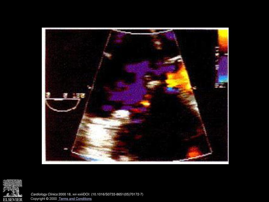 Tricuspic annuloplasty ring with only trivial residual tricuspid regurgitation. (Courtesy of Scott Streckerbach, MD, Boston, MA.) (See also page 748, Fig. 21 in article by Zaroff and Picard.)