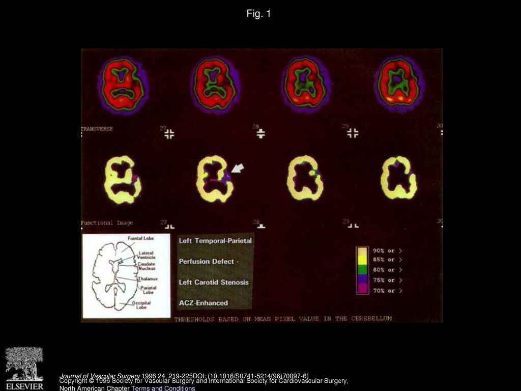 Fig. 1 SPECT SCAN - ACZ enhancement. Preoperative (L) cortical perfusion defect (Ischemia).