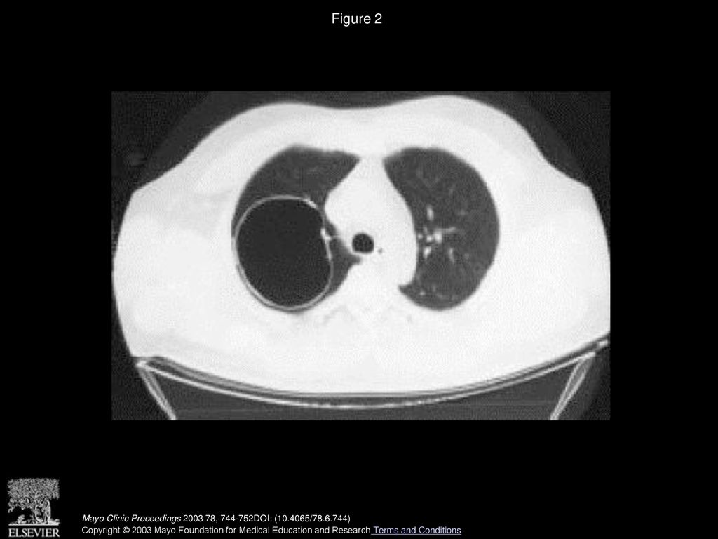 Figure 2 Computed tomogram shows a large smooth thin-walled cyst in the right upper lobe-a bronchogenic cyst.