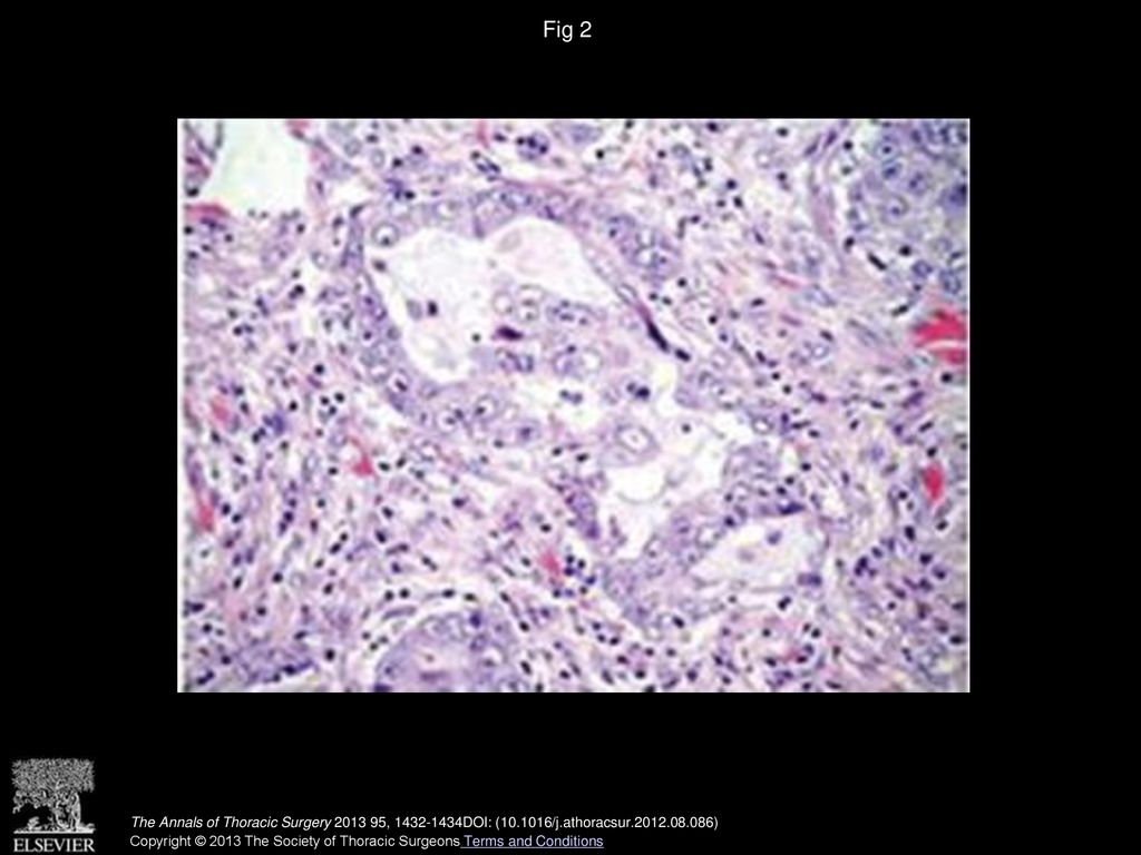 Fig 2 Lung invasive adenocarcinoma (Hematoxilin and eosin stain, original magnification ×400).