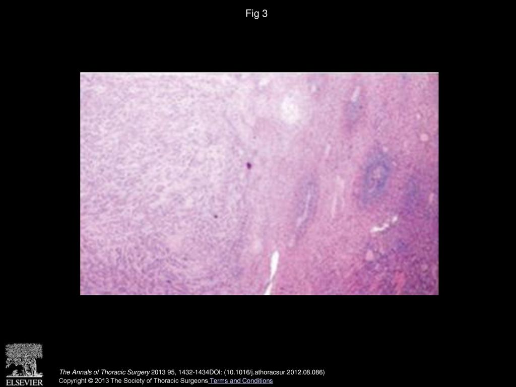 Fig 3 Spleen infiltration by metastatic lung adenocarcinoma (Hematoxilin and eosin stain, original magnification ×40).