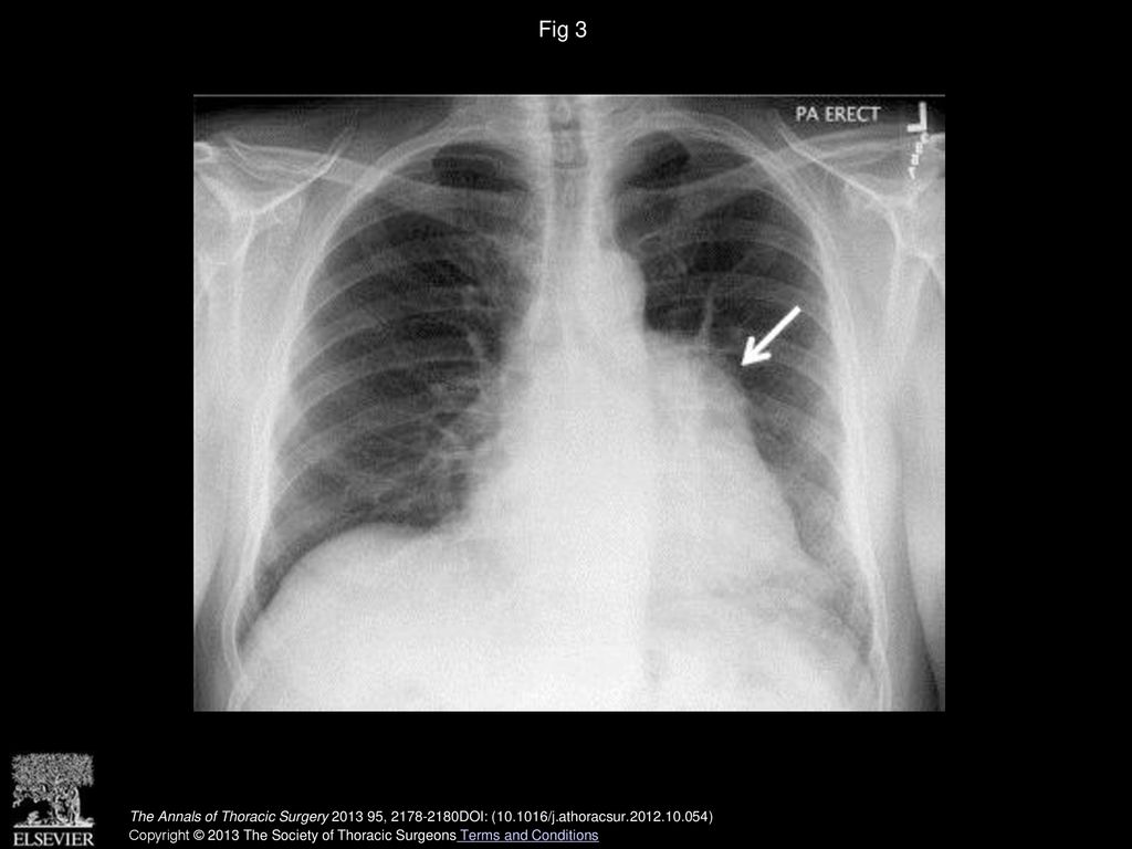 Fig 3 Pulmonary artery chest radiograph shows abnormal contour of the left heart border (arrow) without cardiomediastinal shift.