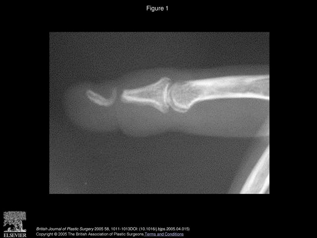 Figure 1 The pre-operative radiograph revealing failed arthrodesis at the DIPJ.